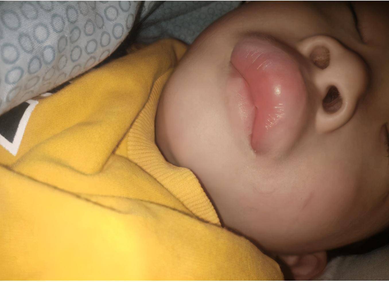 小弟和我睡觉嘴唇被蚊子咬了我该怎么办呢要不要给他抹点风油精