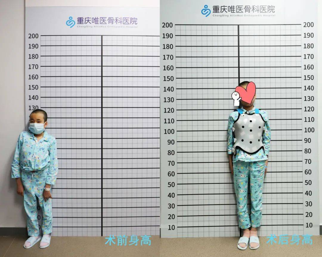 脊柱后凸畸形130度 "问号"少女手术成功长高21厘米_手机搜狐网