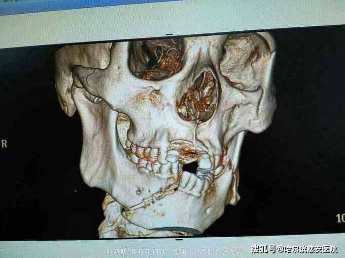 右侧上颌骨额突骨折图图片