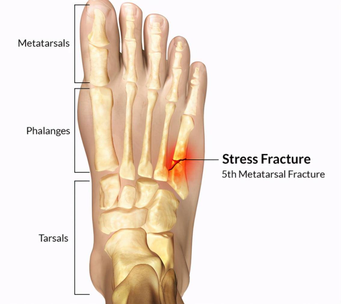 原创致微信运动步数排行榜第一名你走这么多路不怕骨折吗