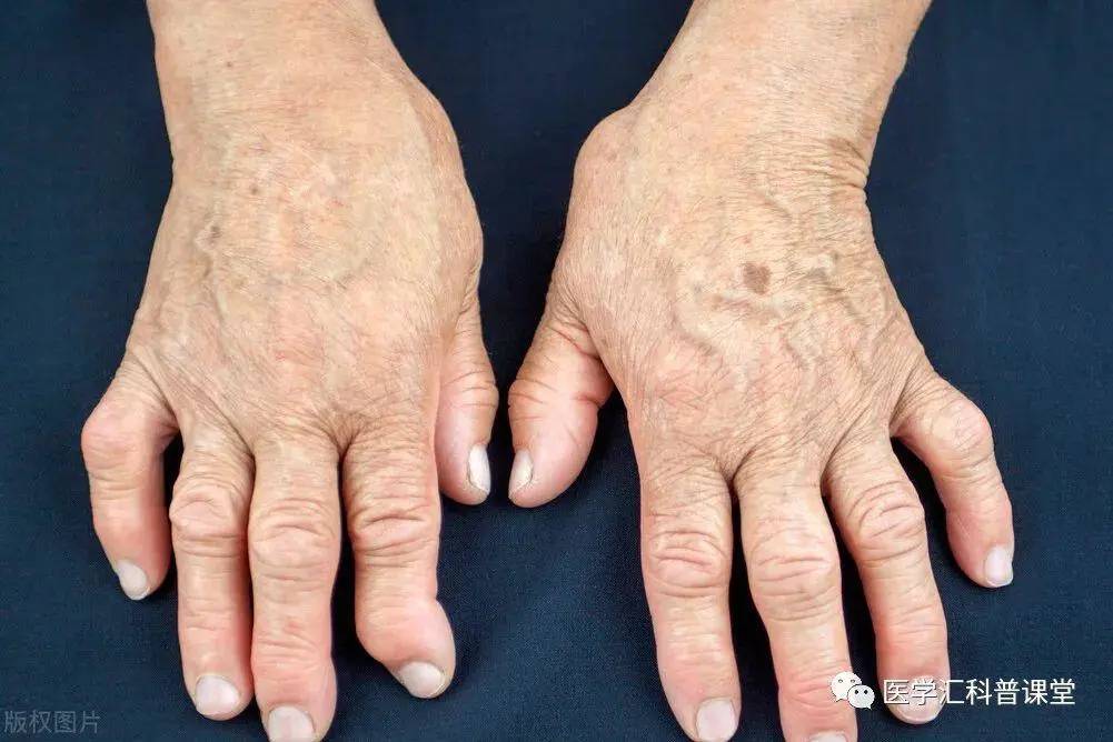 "五痫病""癫狂"之要穴,盖因后溪宣通大阳经气,而具通督脉,定搐搦之功