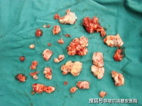 骨软骨瘤病多见于膝关节,游离体可单发或多发,数目可多达数千个