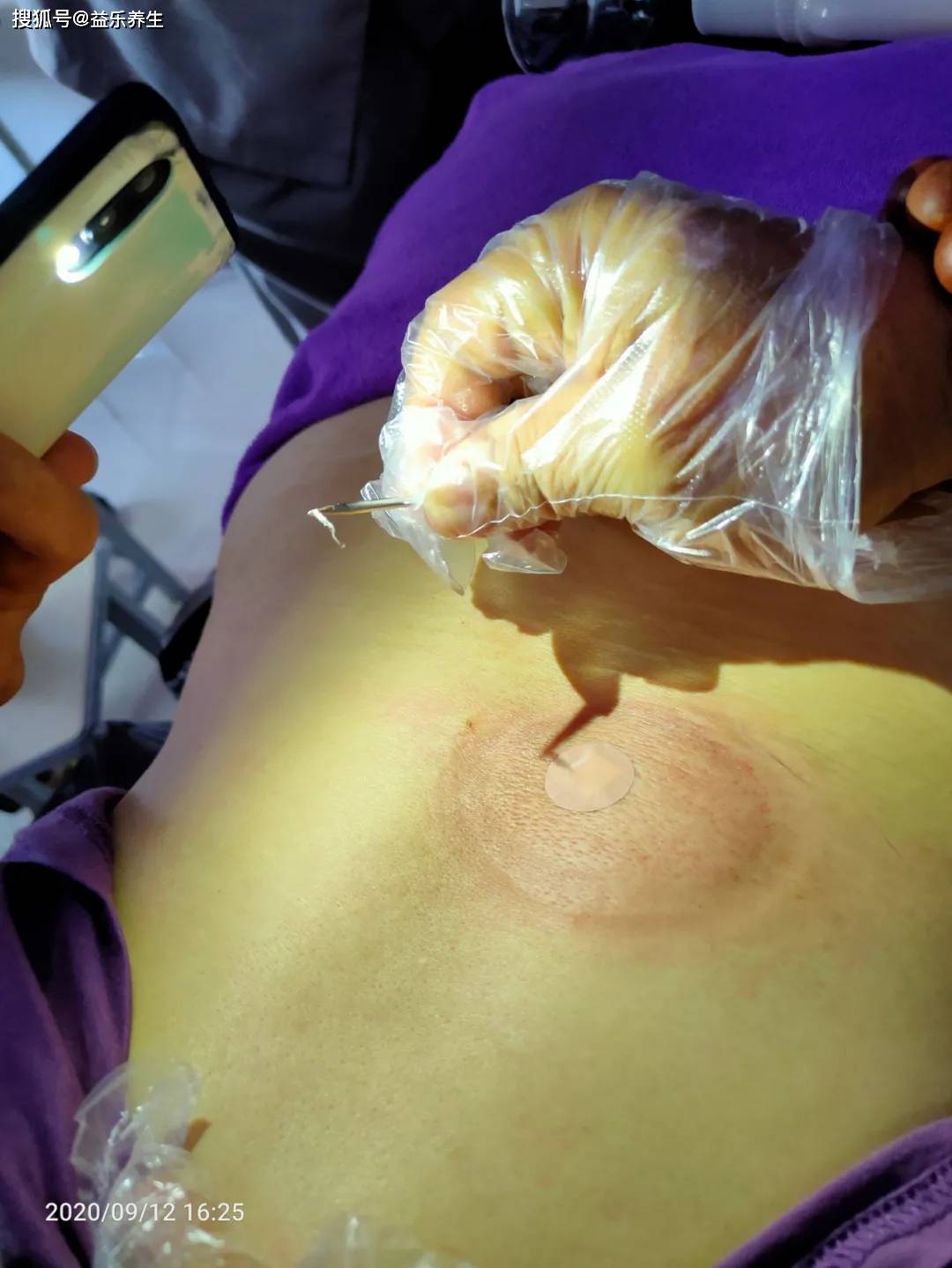 羊毛疔的自我诊断及如何预防_手机搜狐网