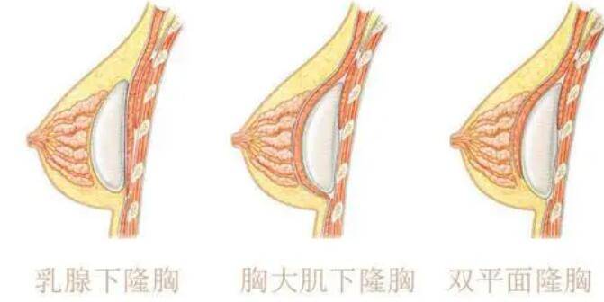 有人说假体隆胸撕逼自体丰胸这些鬼话谣言千万别信