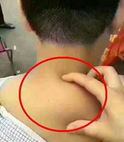 一直以来,张女士就觉得后背肩颈处的"富贵包"令自己很困扰,显得虎背