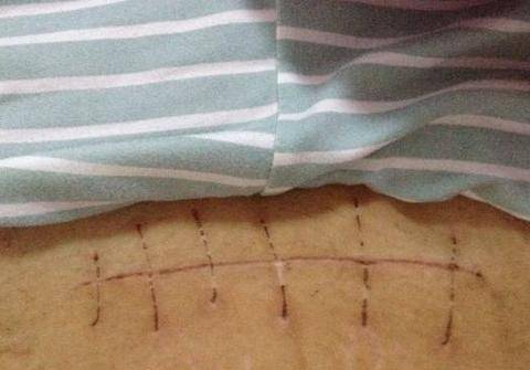 "要是能重来我要选顺产"95后宝妈深夜发朋友圈,哭诉剖腹产辛酸_手机