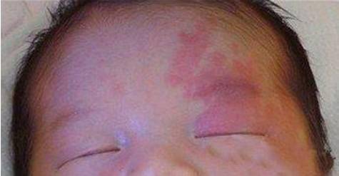 原创现在婴儿为啥总长胎记,产科大夫:孕妈避开这3事,减少娃有印记