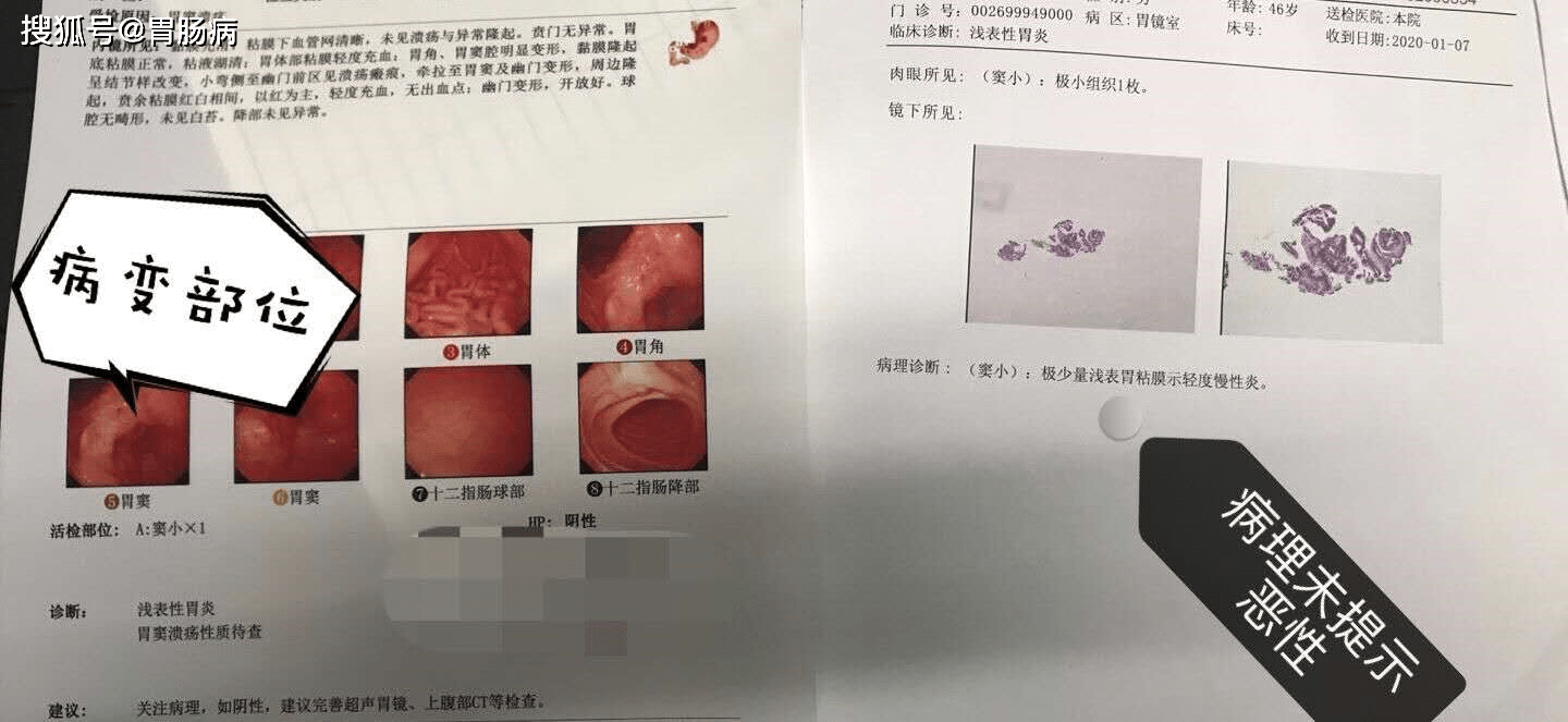 45岁男子胃溃疡一年变胃癌这种溃疡一定要小心