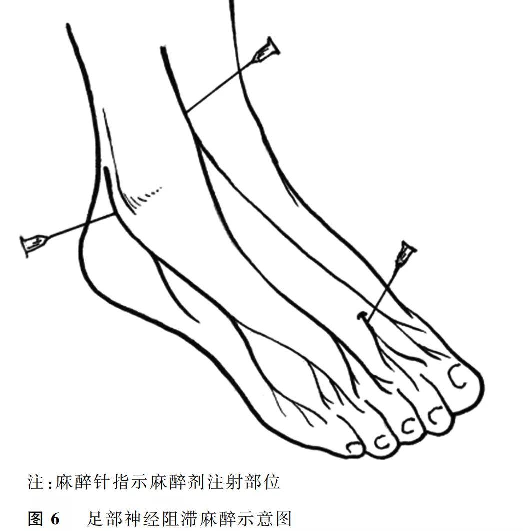 指南与共识多学科合作下糖尿病足防治专家共识2020版精华版Ⅰ