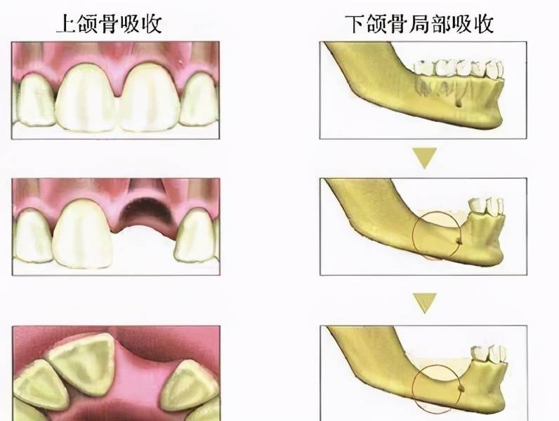 牙槽骨吸收了还能不能做种植牙听听庄博士怎么说