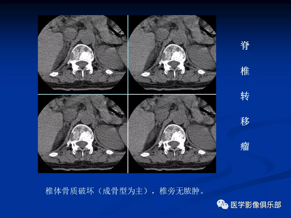 腰椎結核的ct診斷與鑑別