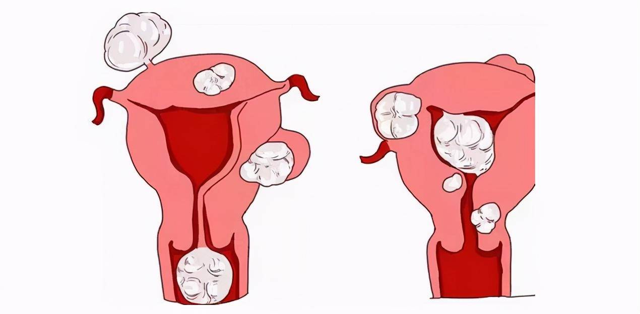 子宮腺肌症:瀰漫性,侷限性怎麼區分?