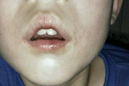 健康生活小指南 11-04 17:46 订阅 腺样体,又称咽扁桃体,增殖体,为咽