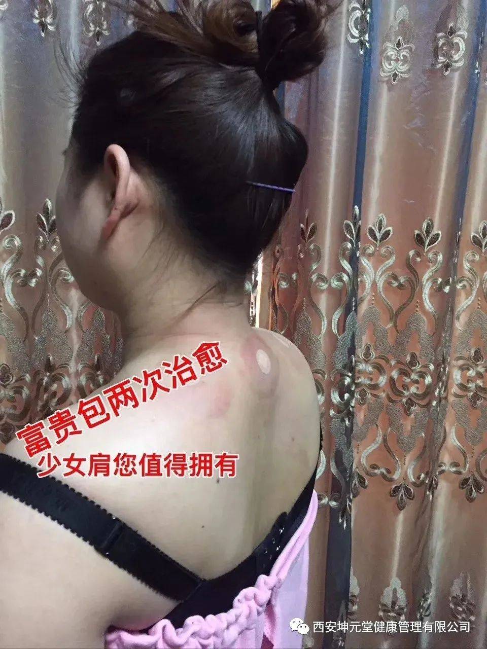 中医讲堂:中医截根术-挑羊毛疔
