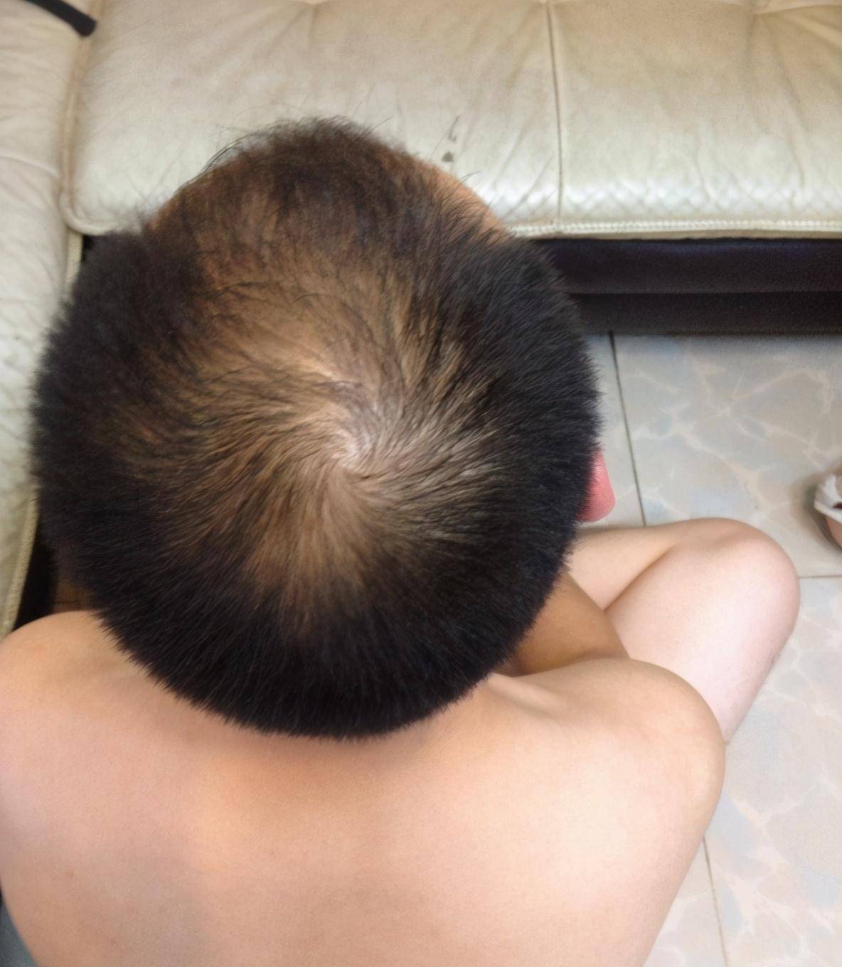 26岁男子花3万治疗脱发失败,如今发际线明显后移,头顶快秃了