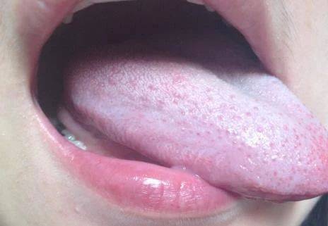 不要忽视口腔黏膜病,出现这几种症状马上看医生