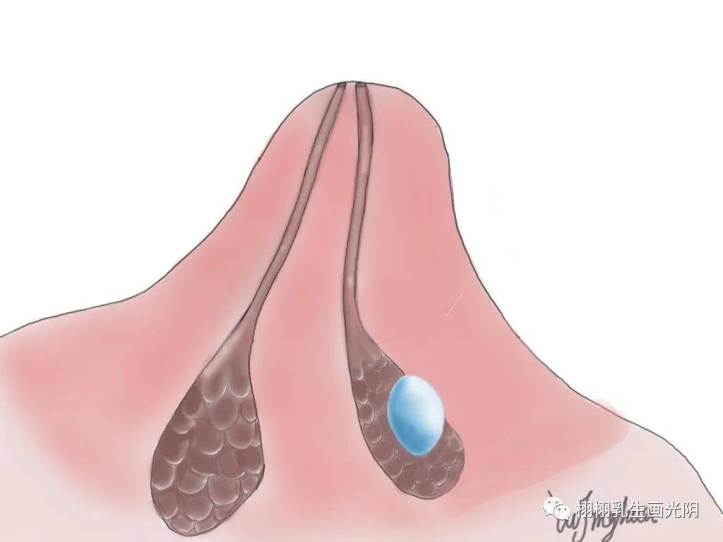 乳房蒙氏结节的图片图片