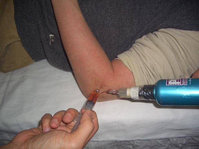 网球肘总是复发找对源头治疗才能一击即中