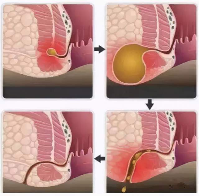 肛肠科患者与医生的真实对话,还原肛瘘的真相,让你不走弯路