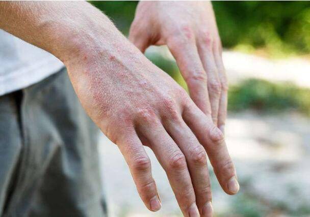 这种原因所致的湿疹患者容易发生 自敏性的皮炎,也就是在 手脚等远处