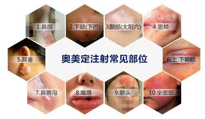 李方奇院长讲述奥美定取出的效果如何