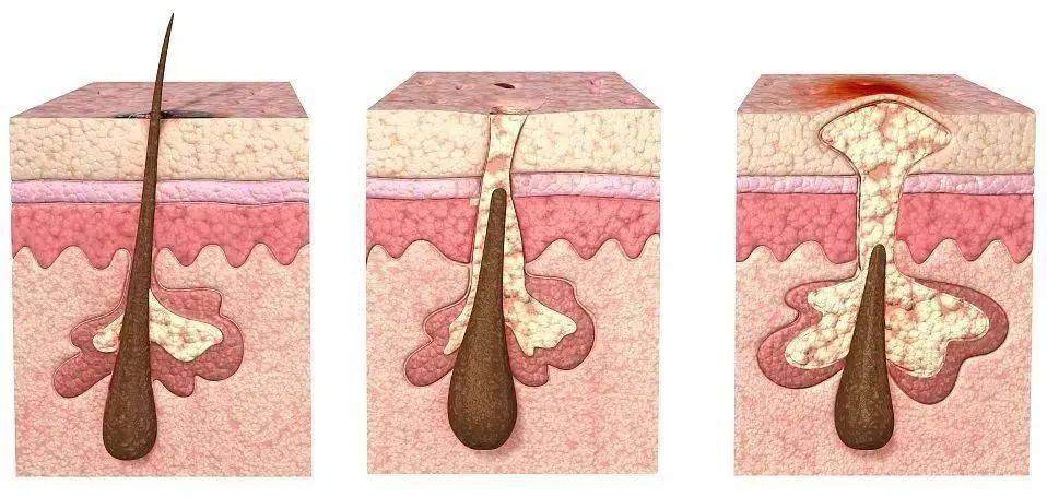 痘痘的发作主要有"三大金刚"参与:出油多(皮脂分泌过多),出路堵塞