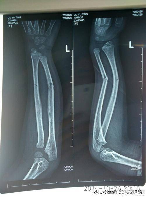 左桡骨下段骨折图片图片