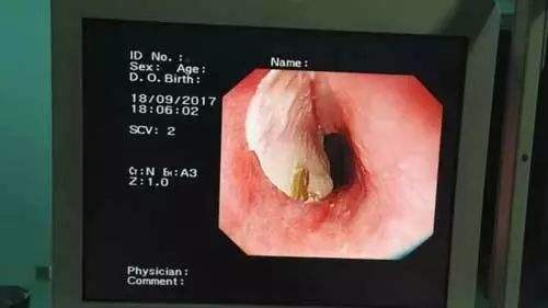 鱼刺卡喉别吞饭喝醋, 分分钟可能威胁您的生命