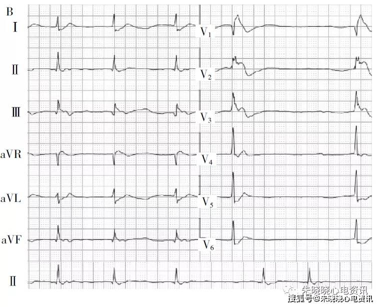siqiiitiii心电图表现图片