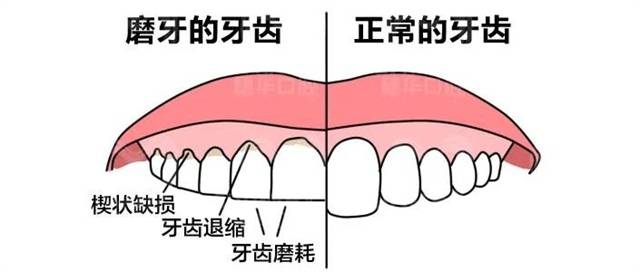 打工人真累"牙齿磨损"都高几倍!