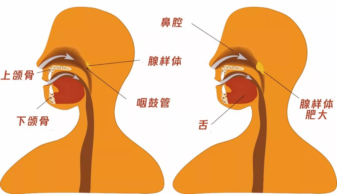 腺樣體也叫咽扁桃體或增殖體,位於鼻咽部頂部與咽後壁處,屬於淋巴組織