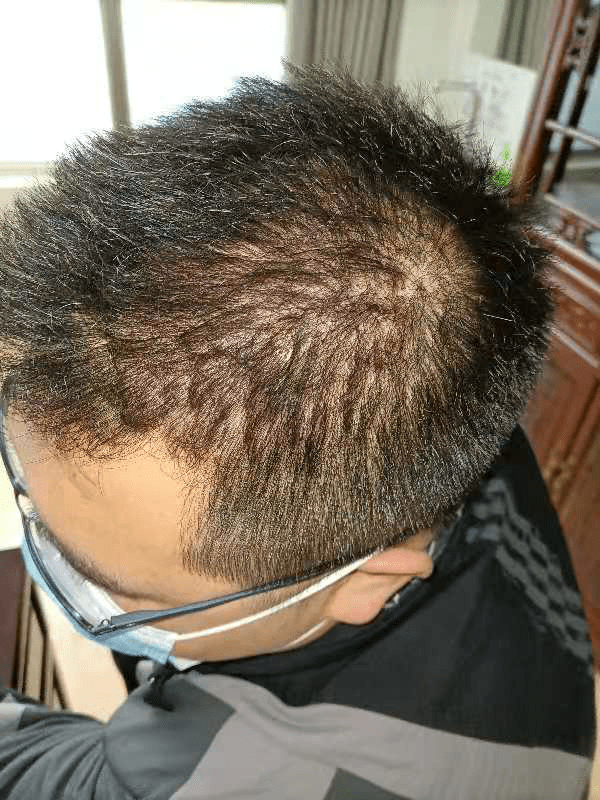 华华主任门诊案例牛皮癣越治越重这4个治疗误区千万别再踩雷