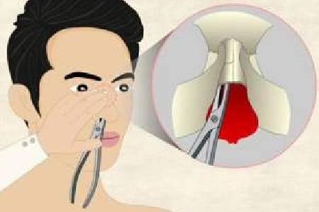 鼻骨复位器图片