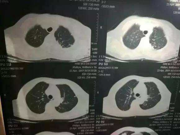 肺結節有什麼症狀多吃2物或許能夠幫助緩解結節潤肺養肺