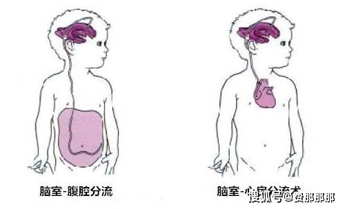 脑积水分流术有哪些缺点
