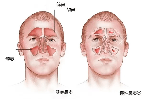 清鼻堂科普:鼻竇炎高發,久治不愈的危害你不會不知道吧!