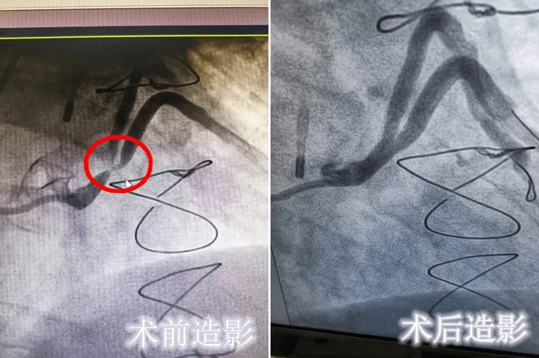 七旬老人心脏搭桥14年后,三支桥血管狭窄程度均超90%!