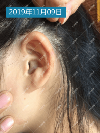 耳朵后米粒状疙瘩图片图片