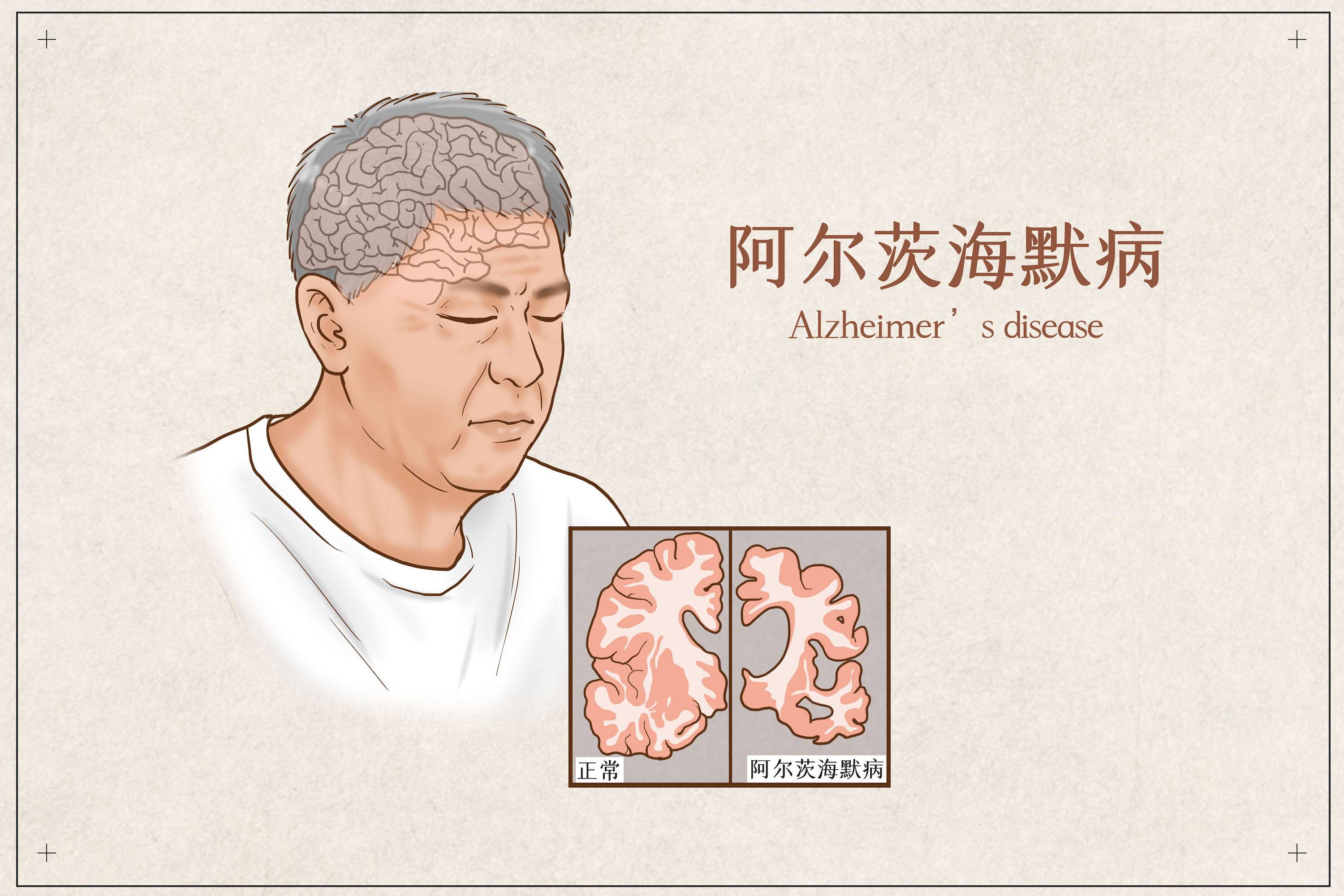 目前,我国阿尔茨海默病患者人数在1000万左右,居世界之首,预计到2050