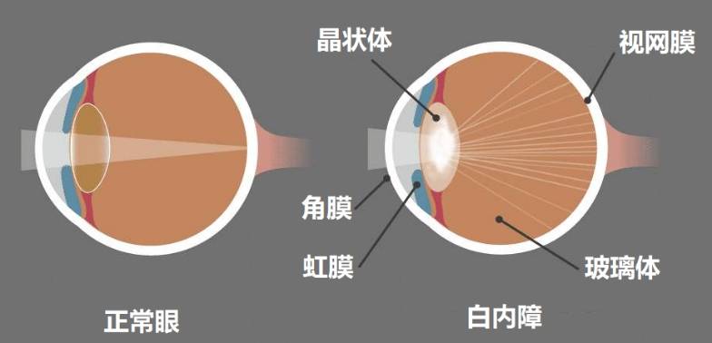 白内障示意图图片