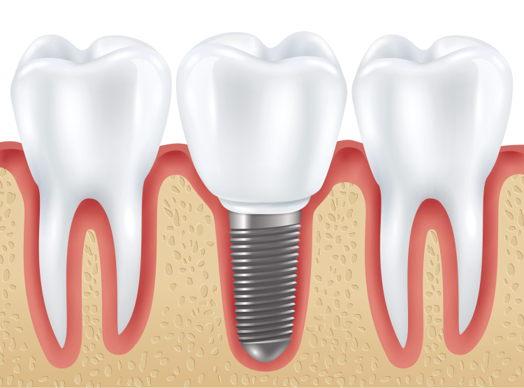 科普种植牙到底能维持多少年
