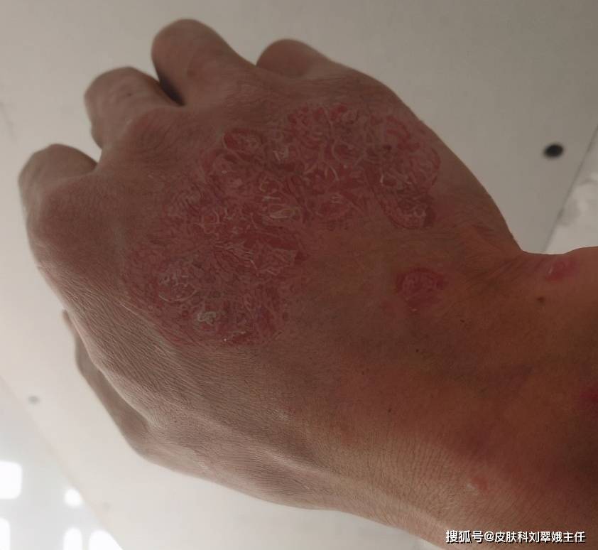 刘翠娥主任门诊案例|中医如何治疗寻常型银屑病?