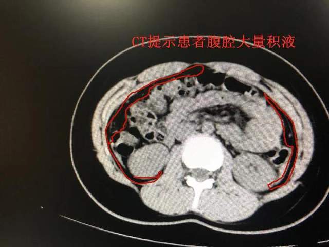 卵巢黄体破裂花季少女大失血险休克