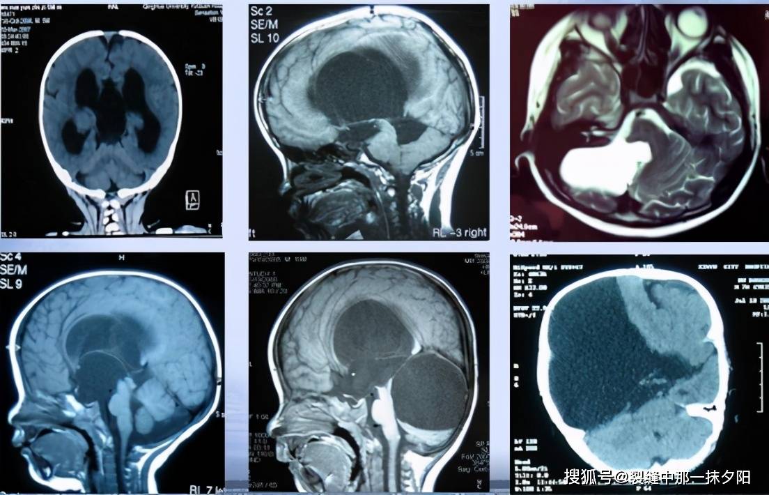 各种部位的颅内蛛网膜囊肿