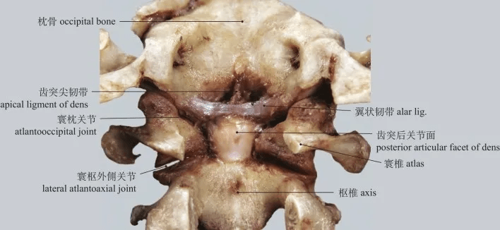 翼狀韌帶和齒突尖韌帶(枕骨大孔後部,寰椎後弓和樞椎椎弓板去除) alar