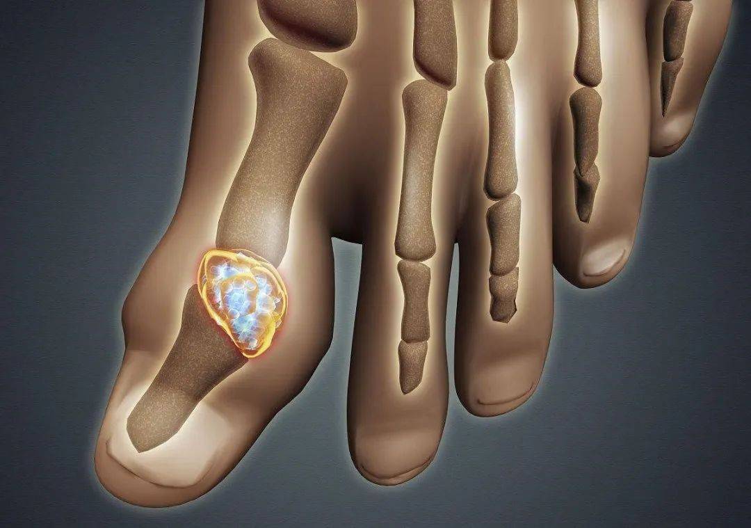 痛风石的危害一定要!_尿酸