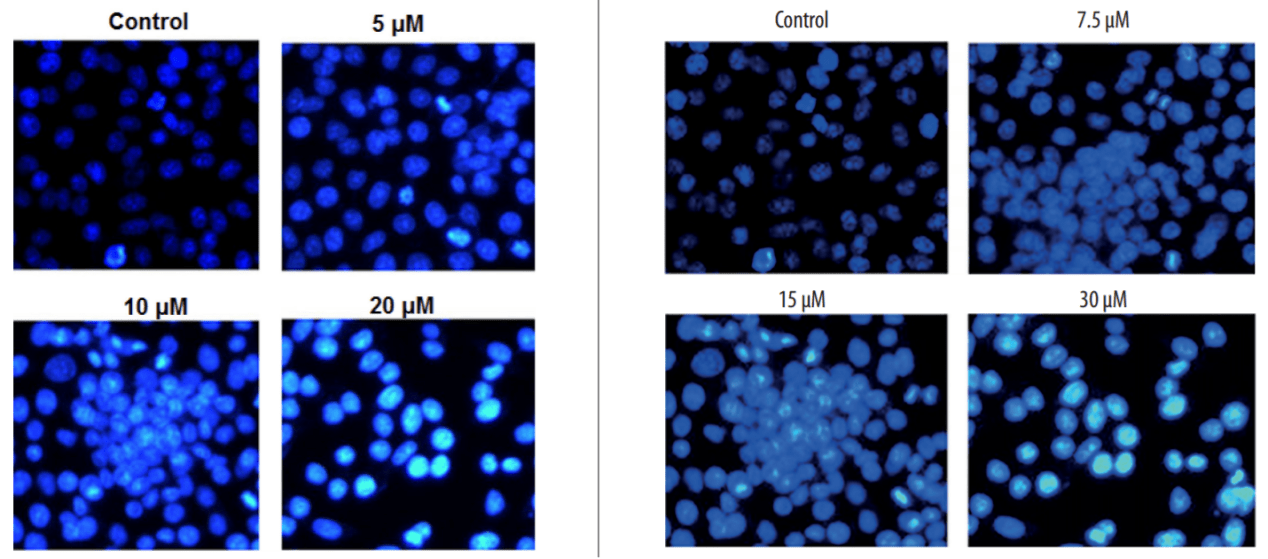 figure 2 利用dapi/pi染色检测骨肉瘤细胞saos-2凋亡.