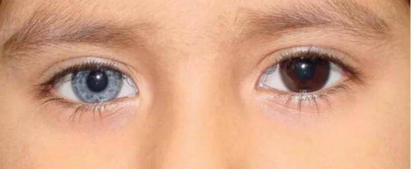 瓦登伯革氏症候群与听力障碍有关吗?-搜狐大视野-搜狐新闻