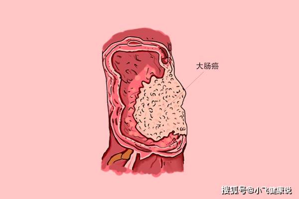 原創大腸有息肉建議有4個變化可能要發生癌變