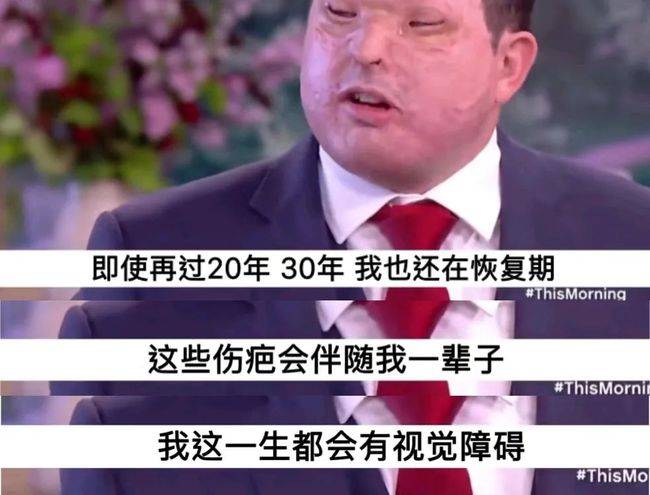 被潑硫酸的她們除了毀容還要面對什麼